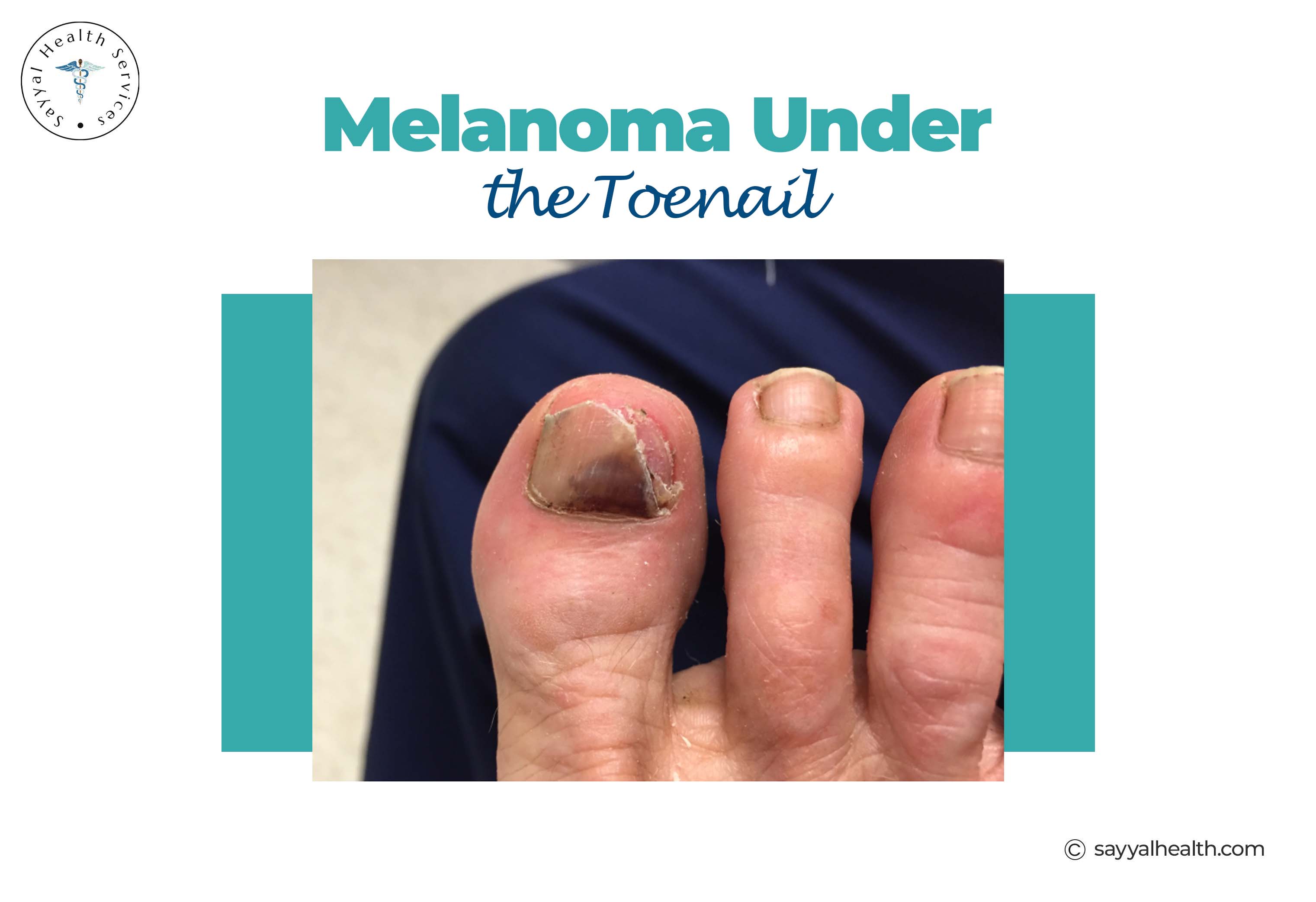 Melanoma under toenail showing dark pigmentation on big toe